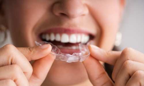 dental aligners in low price