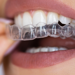 TEETH STRAIGHTENING WITH ALIGNER